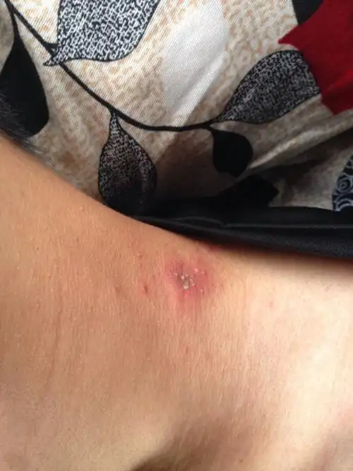 我脖子上长了红斑还有白色的像白头脑一样,不疼不痒,请问是什么?