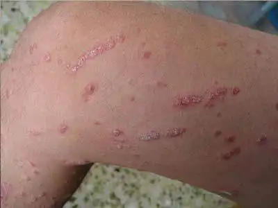 牛皮肤癣的症状图片皮癣