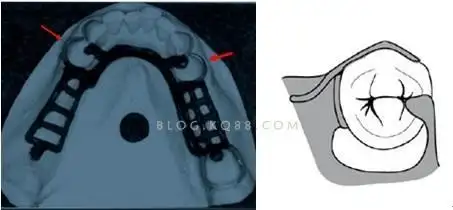 游离端缺失末端基牙十大推荐铸造卡环莒县万洁口腔