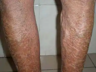 北京鱼鳞病专科医院在哪里