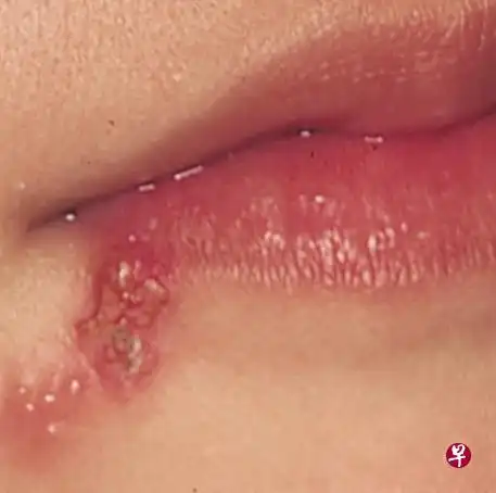 嘴角单纯疱疹