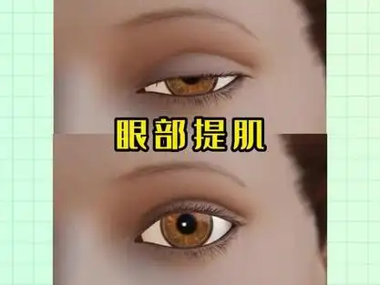 整形医生林文韬提肌无力不想要双眼皮也可以,只要瞳孔暴露度出来,一