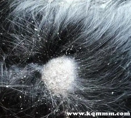 头皮上有大块头皮屑是怎么回事啊头皮屑一大块一大块怎么治疗