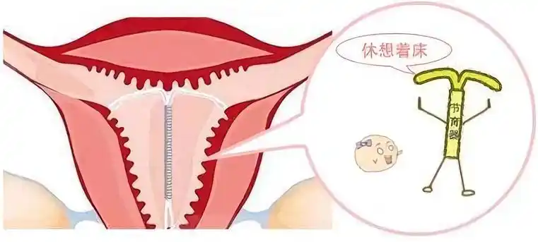 当有胚胎欲在子宫内着床时,不断动作的节育环刮擦子宫壁,造成子宫的