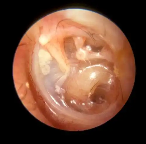 粘连性中耳炎怎么治疗