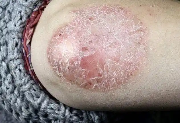 银屑病病症状图片_银屑病求医网