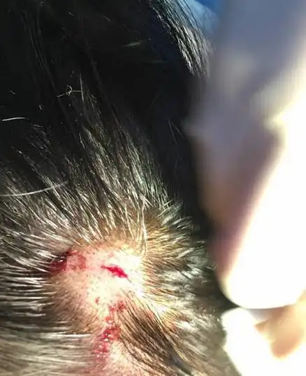 武大校花拍戏头部被砸 伤口血流不止