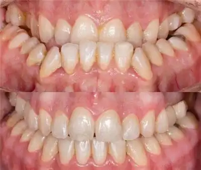 地包天矫正对比