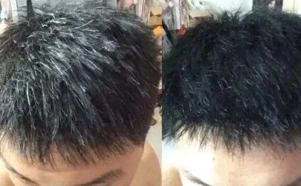 头顶长白发是什么原因白头发长哪里最危险