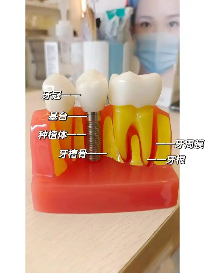 种植牙完整流程图.