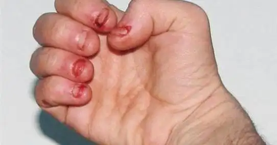 非得要到处跑来跑去,动小时候咬指甲,现在手特别丑确实很丑,而且没