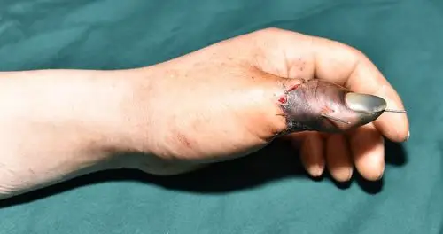 男性患者,31岁,拇指旋转撕脱性离断再植术后坏死.