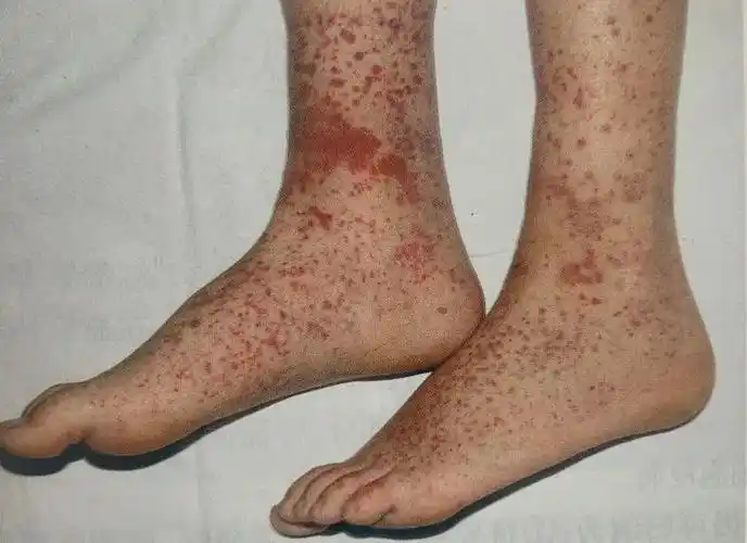 皮肤上突然出现的淤血,可能是偶然发生的,也可能预示着血管或血液疾病