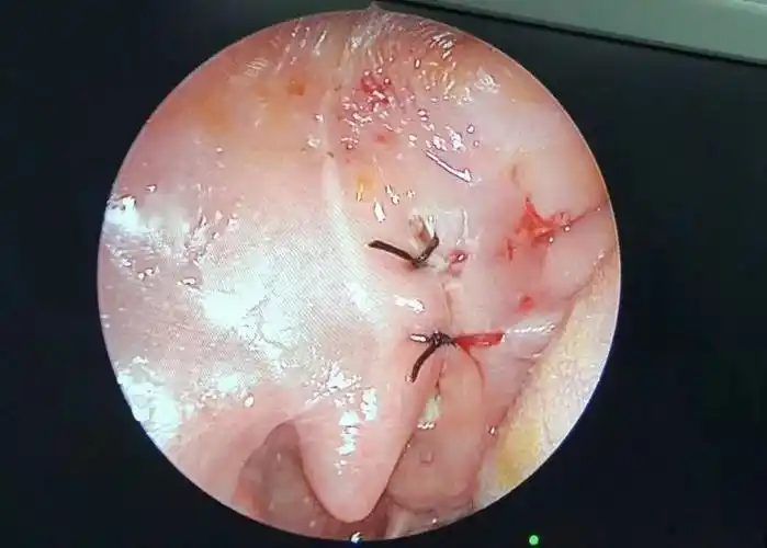 手术缝合后的创口