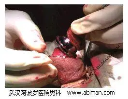 老年人包茎包皮环切手术过程直播(图)