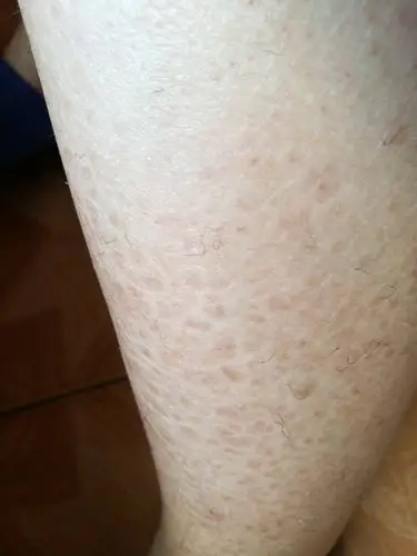 腿上有一小块的东西 问问怎么回事