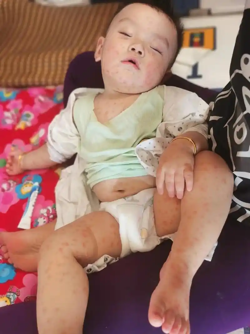 疫苗过敏发烧40℃,吃了布洛芬,结果身上长满了疹子,估计大家 - 抖音