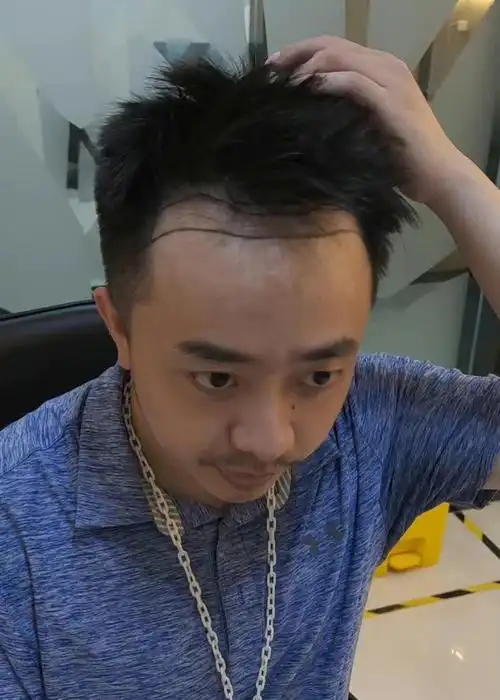 m型发际线植发改善10个月效果