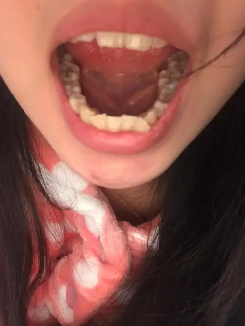 牙齿突出虎牙突出门牙歪斜不能很好的闭合