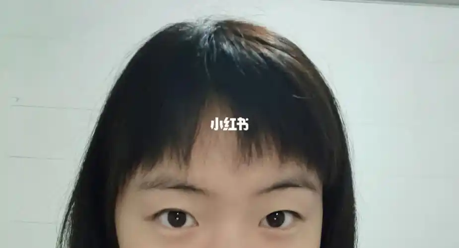 双眼皮_肌无力_大小眼_眼部_武汉双眼皮_美妆_医美整形