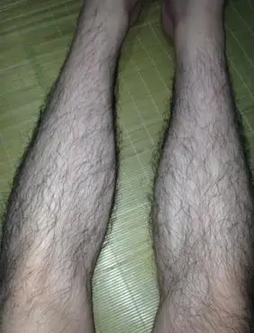 男人腿毛长而且黑,不敢穿短裤,也不敢去游泳,内附图 不喜勿进