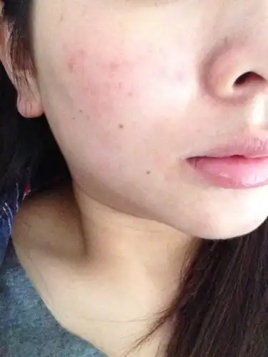 皮肤过敏的主要表现就是面部发红,引起过敏的原因有很多,比如一些化妆