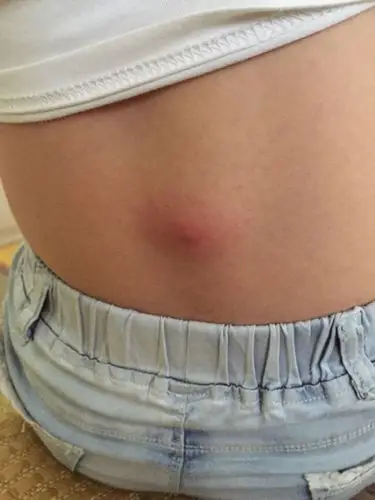 背上长了一个大结子,中间有脓包,摸芦荟水好不