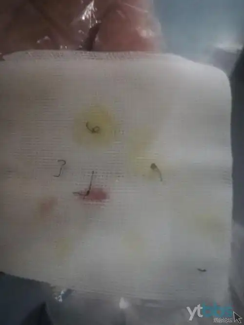 腚底下的事,如果大夫说做pph手术,请各位记得,万不得已千万不要做,太