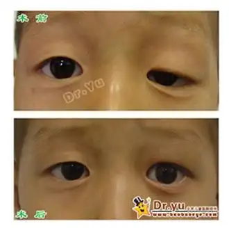 上睑下垂手术时机选择