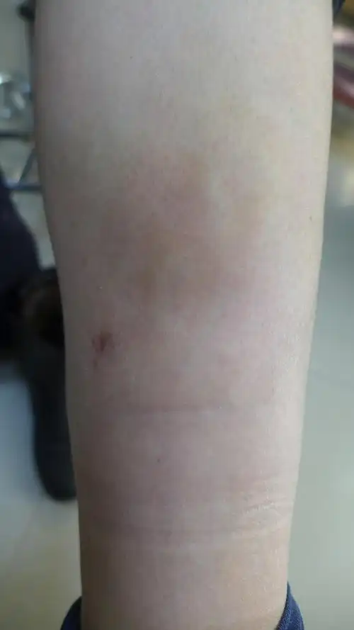 皮肤肿胀伴疼痛当心是硬化性脂膜炎