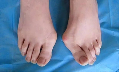 有了大脚骨(拇外翻),该怎么办