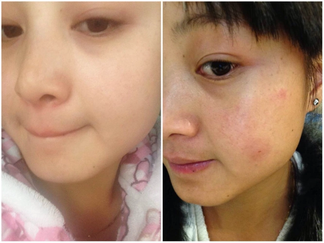 这是用我们祛斑部分前后对比图