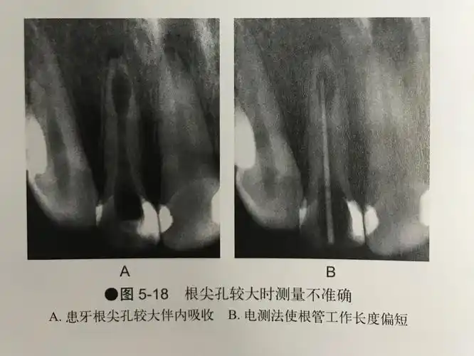 上颌第一磨牙根管治疗流程