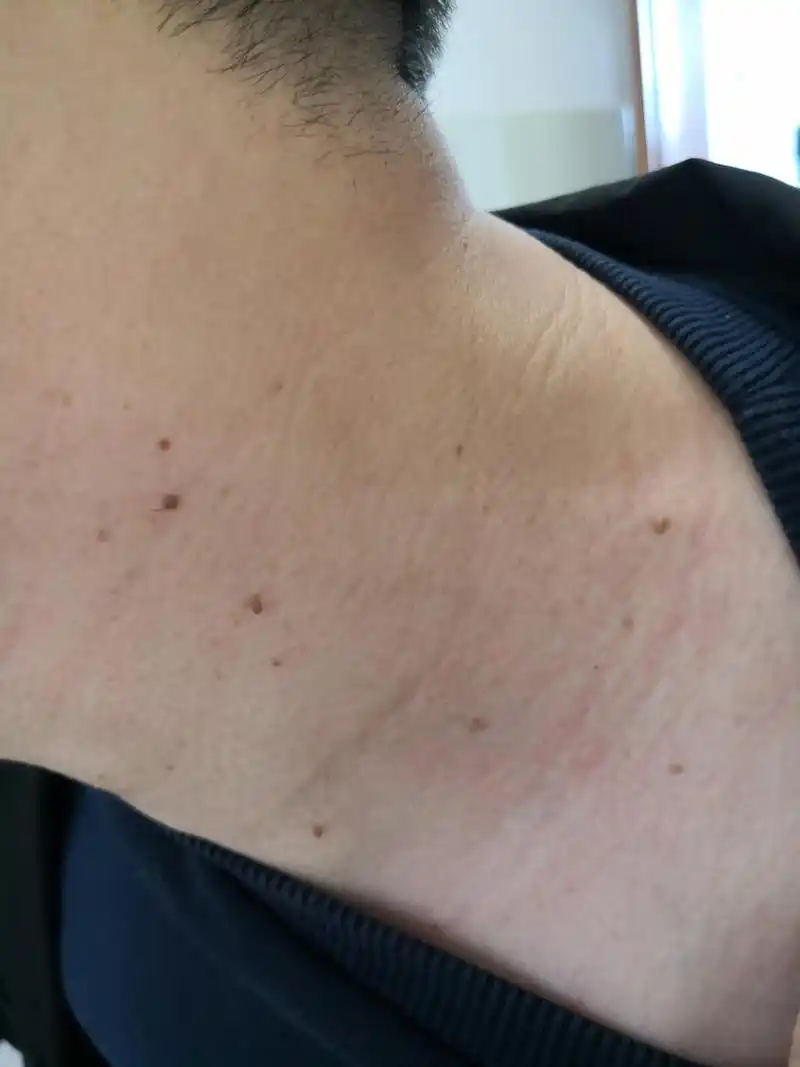 操作简单方便效果可靠#皮赘##丝状疣# 要与丝状疣相鉴别.#激光美容