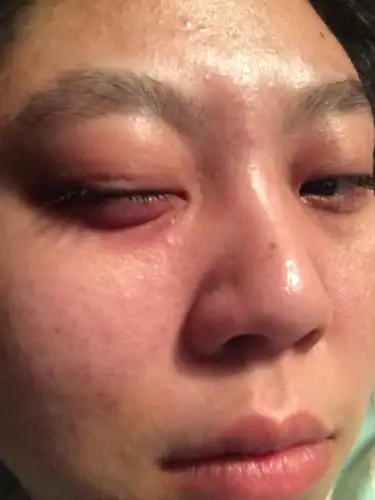 这是怎么回事经常下眼袋会突然肿起来一