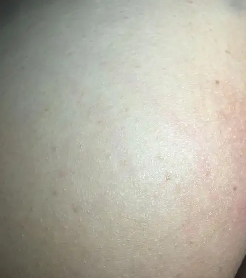 怀孕四个多月,突然发现屁股上长了好多褐色微微凸起的小斑点.