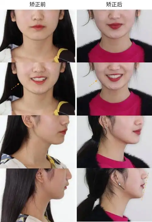 > 肉嘟嘟到女神的蜕变,矫正改变的不仅是一口乱牙肉脸,配上稍乱的牙齿