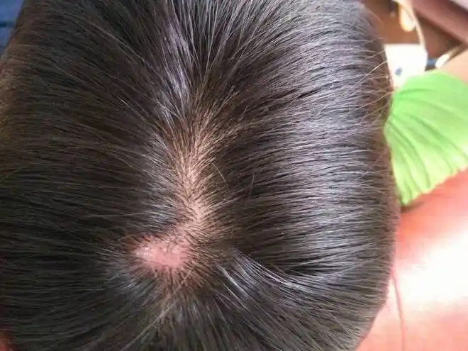 一,头皮毛囊炎引起毛囊炎的病原菌,主要是金黄色葡萄球菌,偶有表皮