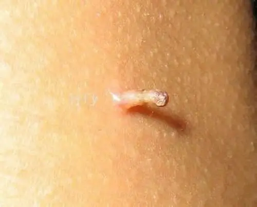 丝状疣的对比图片