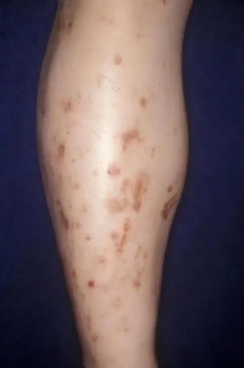 儿童糖尿病患者腿上有斑要小心,可能是胫前色素斑|血管|治疗|皮肤病