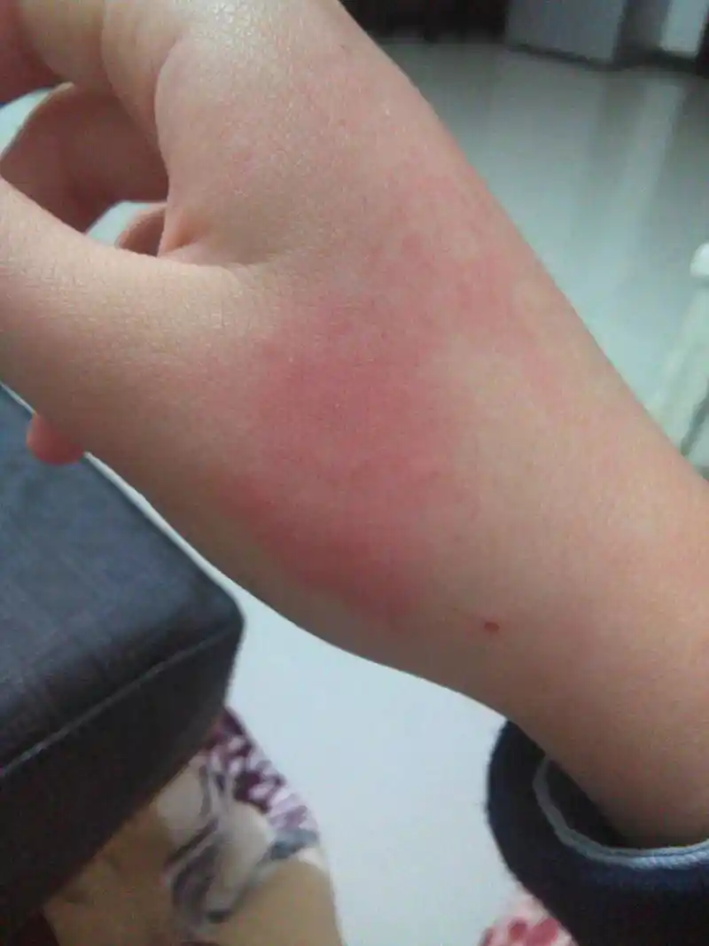 我洗手,可能水有点烫,手好痛,还有红色的痕迹,到底怎么了?