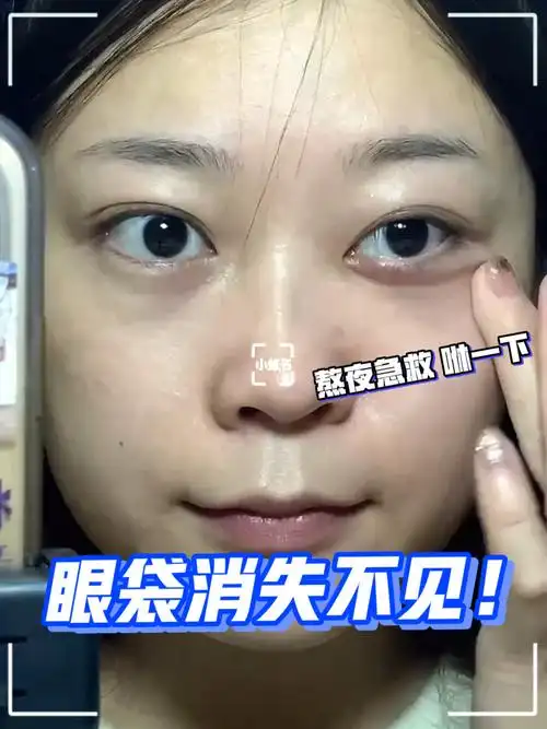 熬夜水肿眼袋急救60咻一下眼袋不见了