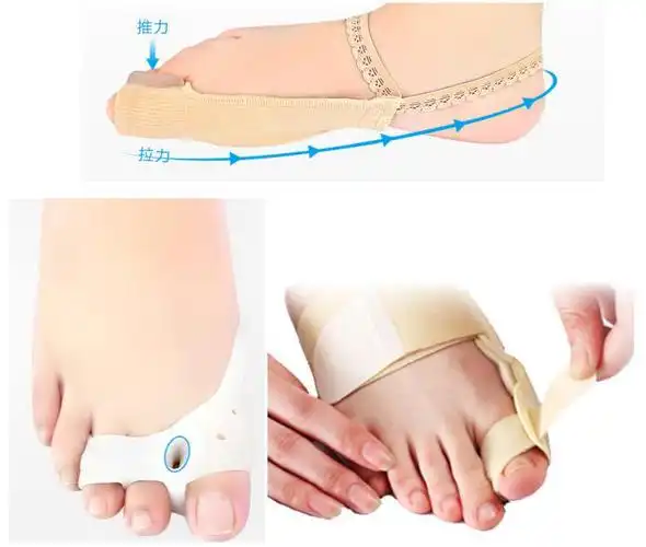 拇外翻最佳治疗方法是什么