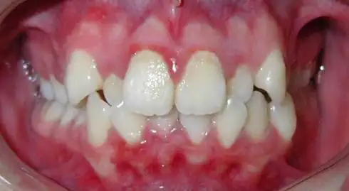 真相解密:虎牙为什么不能拔掉?