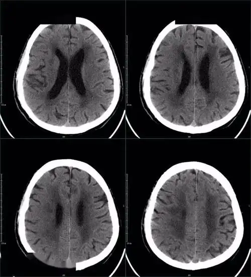 67超急性期大面积脑梗死ct平扫表现