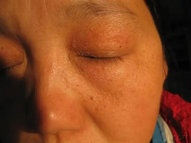 看图识病----------粟丘疹 - 皮肤及性传播疾病讨论版 - 爱爱医医学