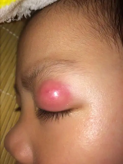 帮忙看下这是什么病,小孩上眼皮肿起个包