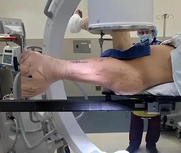 做完截肢手术后切下来的废肢去哪了用途丰富超乎你的想象