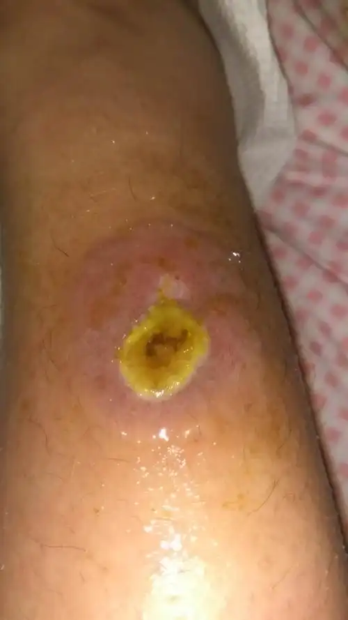 热水袋低温烫伤两个多月了一直在医院换药的本来已经结痂快好