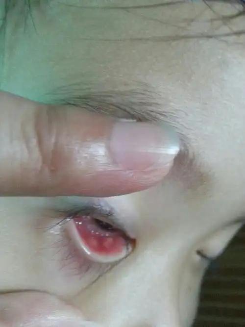 宝宝下眼睑肿,扒开眼睛有白色东西